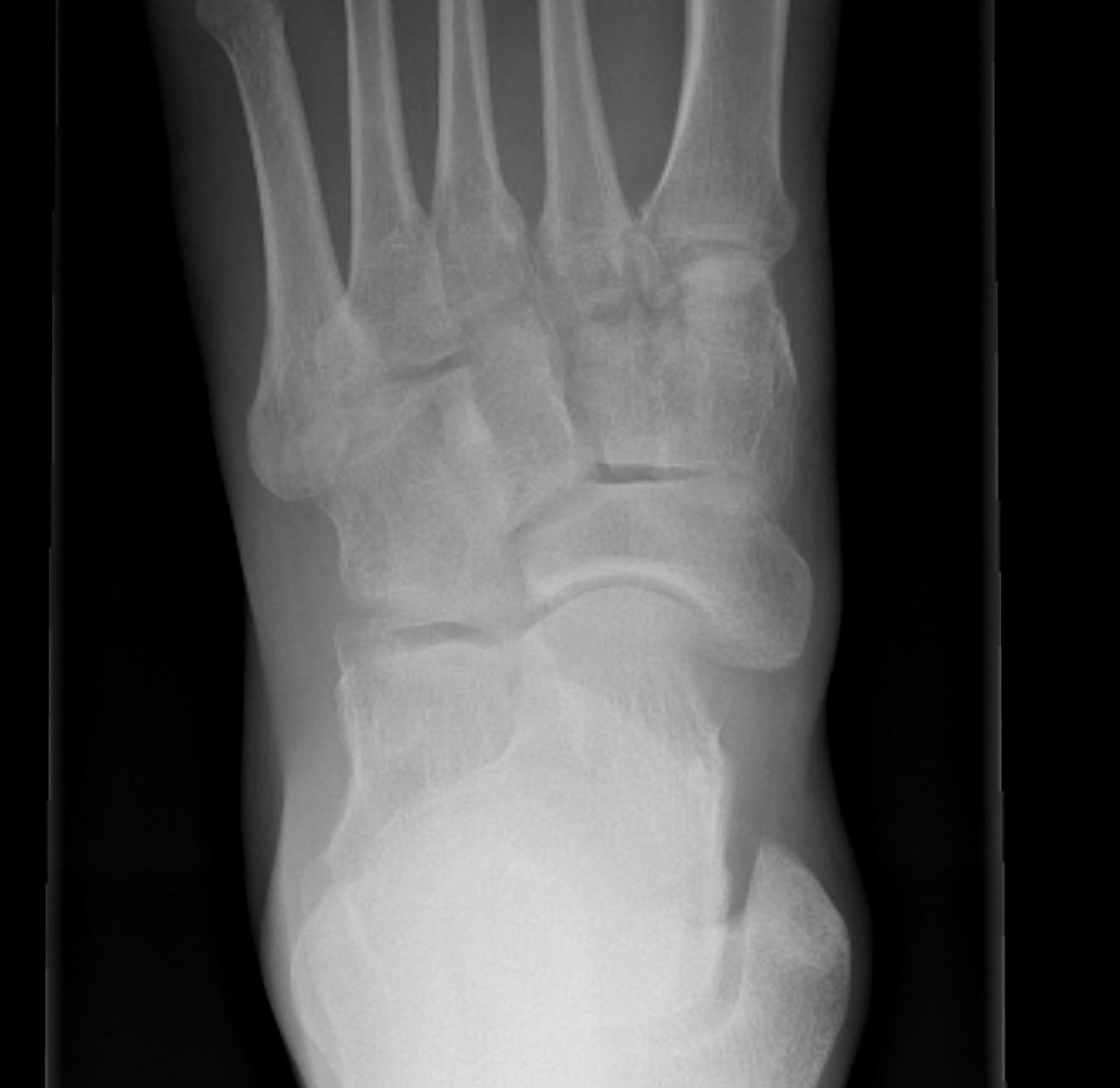 Accessory Navicular Cornuate